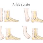 how long does a sprain mcl take to heal